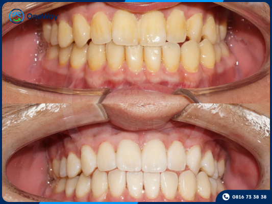 hiệu quả tẩy trắng răng