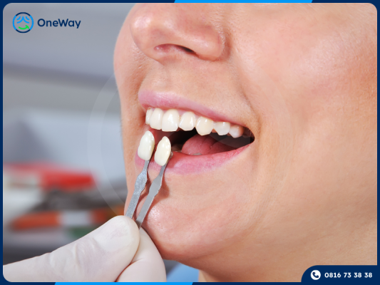 bọc sứ cho răng thưa