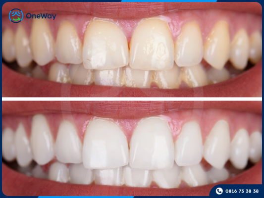 hiệu quả tẩy trắng răng