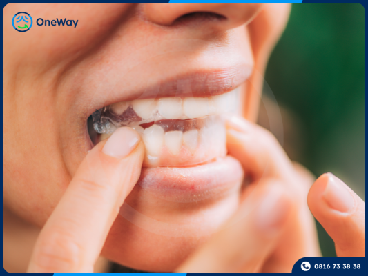 miếng dán trắng răng