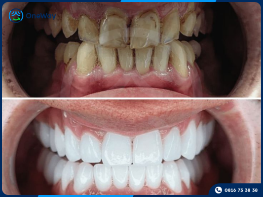 hiệu qủa thẩm mỹ với bọc răng sứ