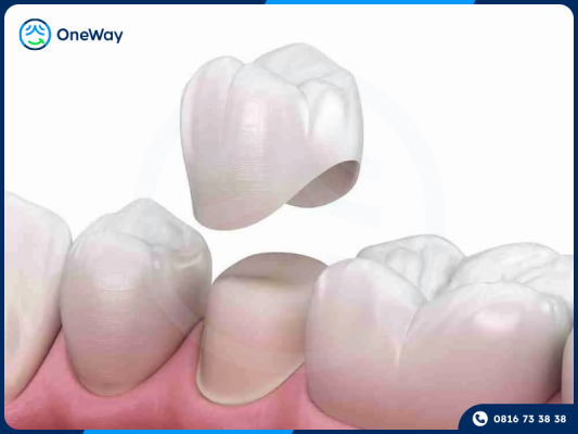 bọc răng sứ