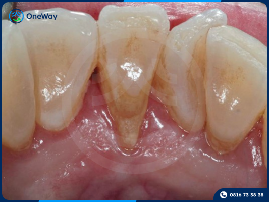 tụt nướu do vôi răng