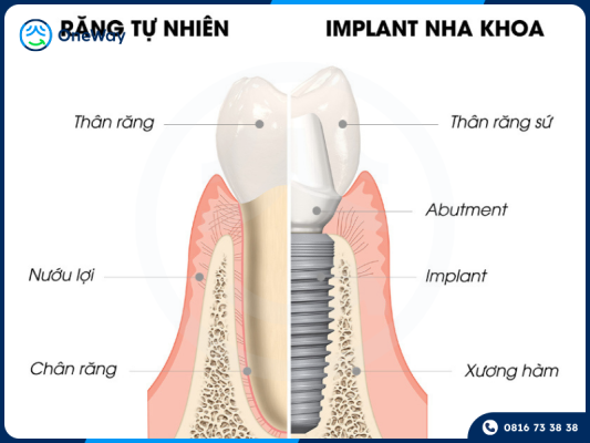 trồng răng Implant