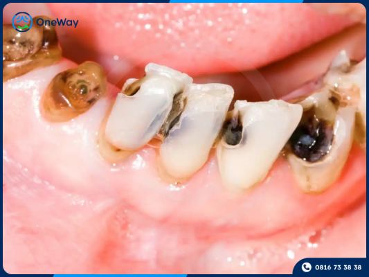 sâu răng gây viêm tủy