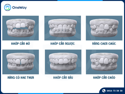 các trường hợp nên niềng răng
