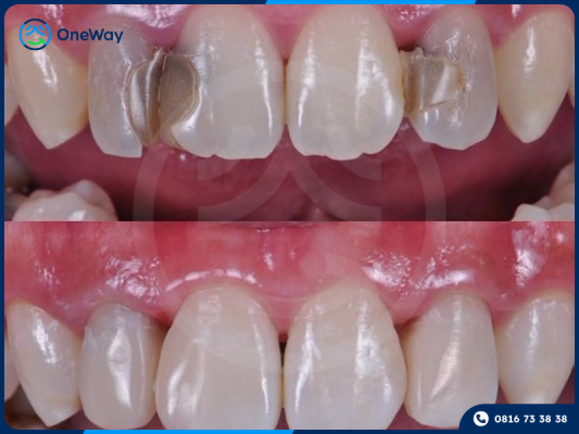 hiệu quả của trám răng