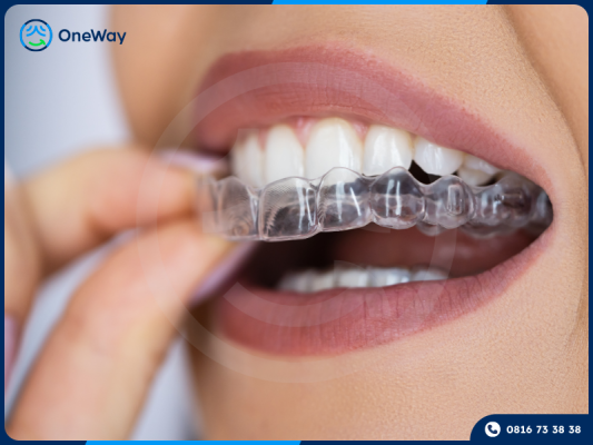 niềng răng trong suốt