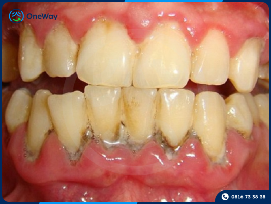 cao răng gây đen viền nướu