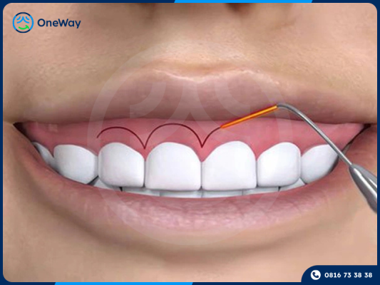 phẫu thuật cười hở lợi bằng laser