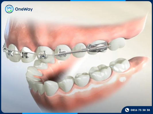 niềng răng 1 hàm