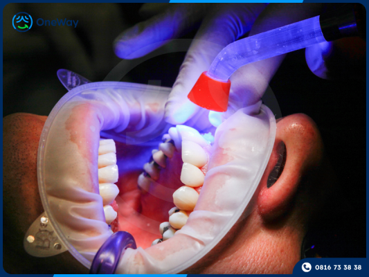 trám răng khắc phục răng bị mẻ