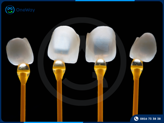 mặt dán sứ Veneer