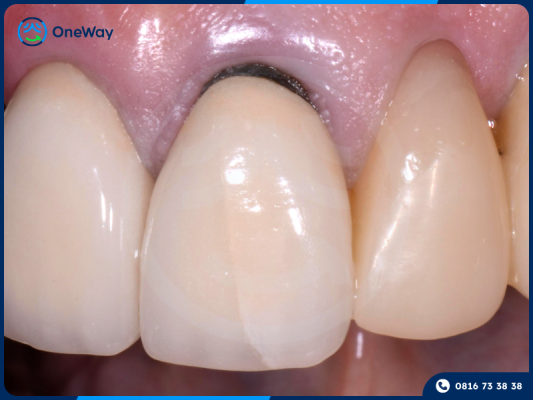 răng bị đen viền nướu