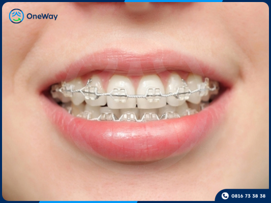 niềng răng mắc cài pha lê