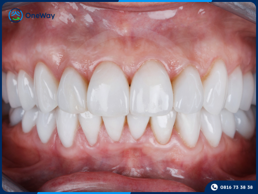 ưu điểm của mặt dán sứ Veneer