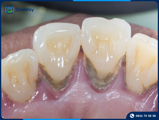 tụt nướu lộ chân răng