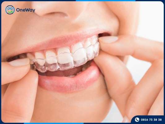 niểng răng 1 hàm