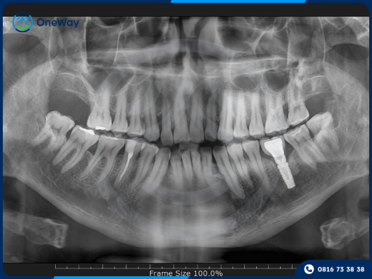 trổng răng Implant có nguy hiểm không