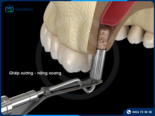 nâng xoang ghép xương