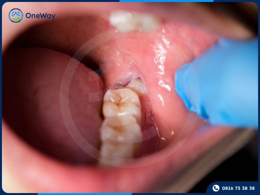 lợi trùm răng khôn