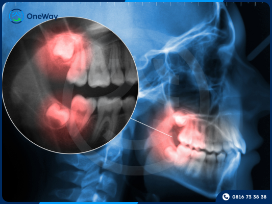 răng khôn mọc lệch