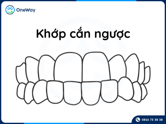 niềng răng khớp cắn ngược