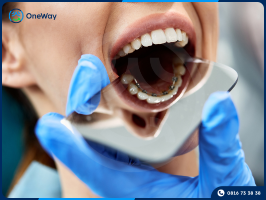 niểng răng mặt trong