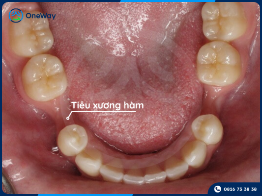 mất răng lâu năm gây tiêu xương hàm