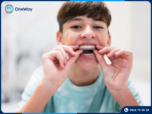 niềng răng trong suốt