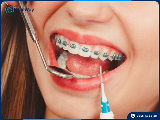 vệ sinh răng niềng