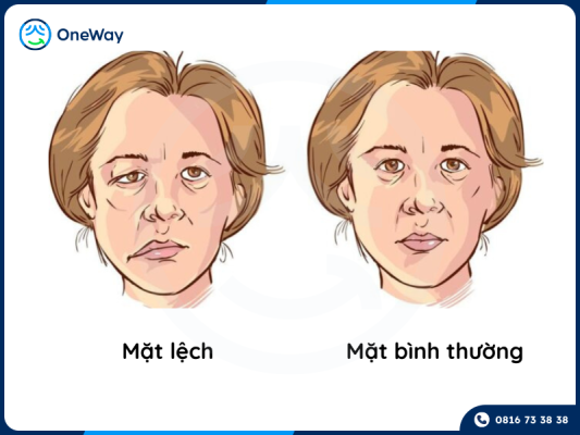 mặt lệch có niềng răng được không