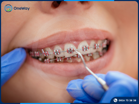 niềng răng mắc cài