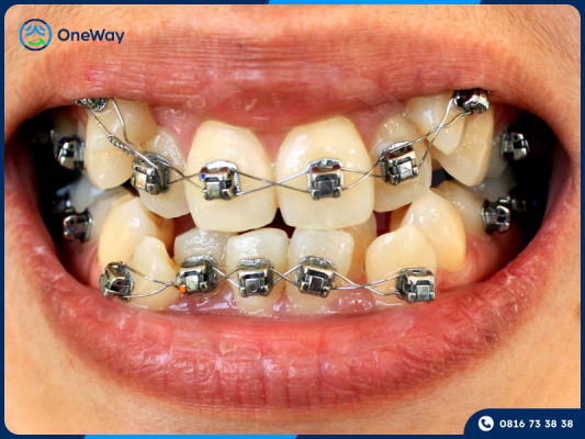 niềng răng mắc cài tự buộc
