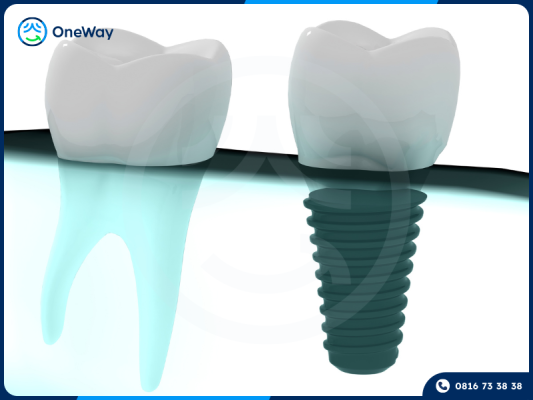 công nghệ cấy răng Implant