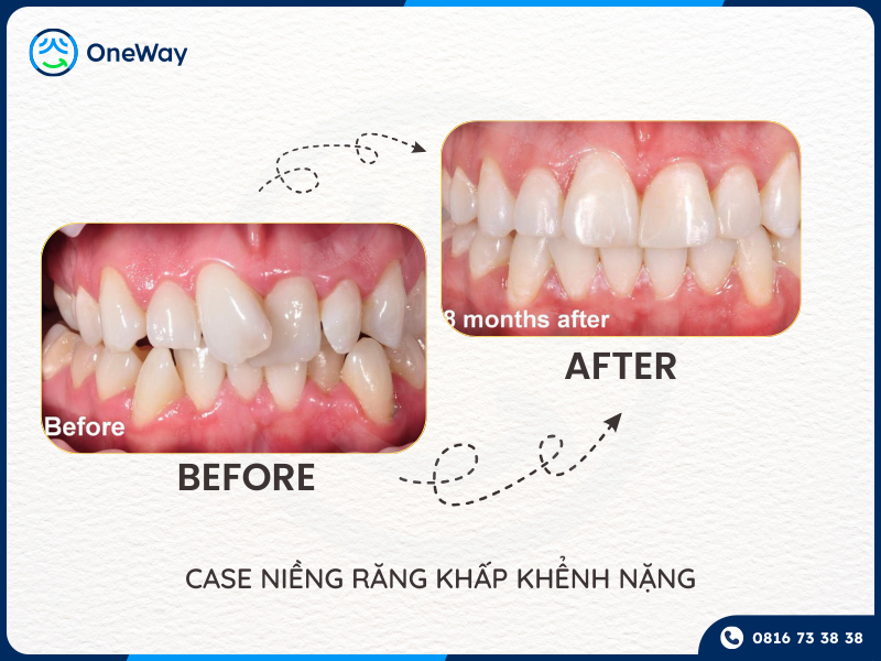 niềng răng lệch lạc nặng