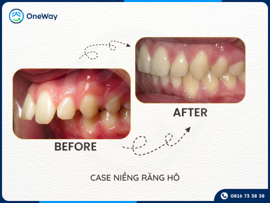 top những ca niềng răng khó nhất