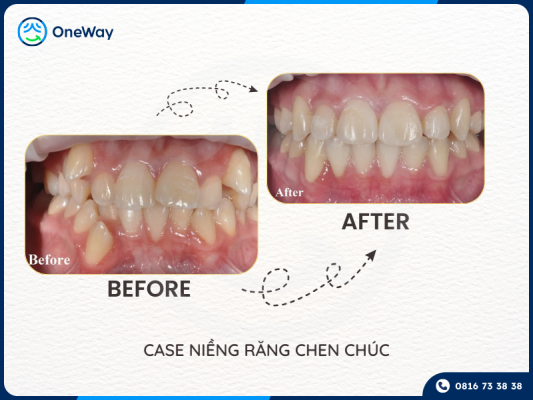 niềng răng khấp khểnh