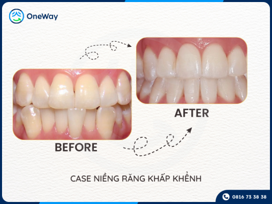 niềng răng trong suốt