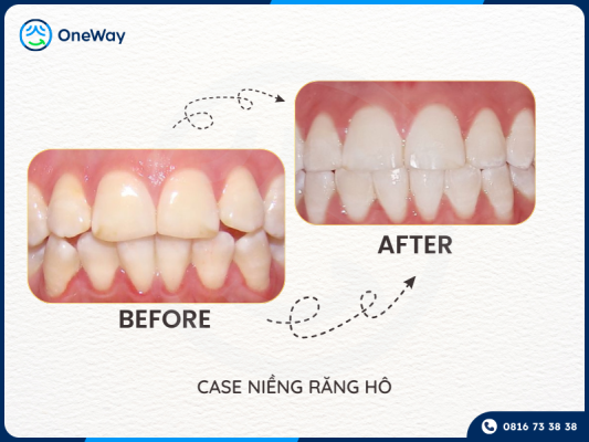 niềng răng khớp cắn đối đầu