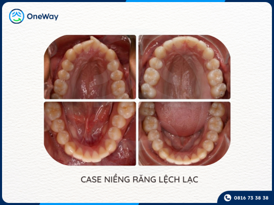 niềng răng với Invisalign