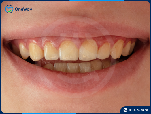răng ố vàng