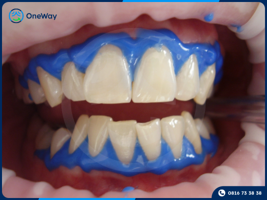 tẩy trắng răng bị ê buốt do nguyên nhân nào