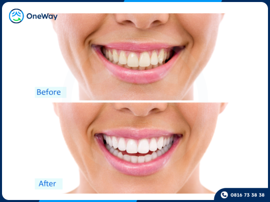 hiệu quả tẩy trắng răng