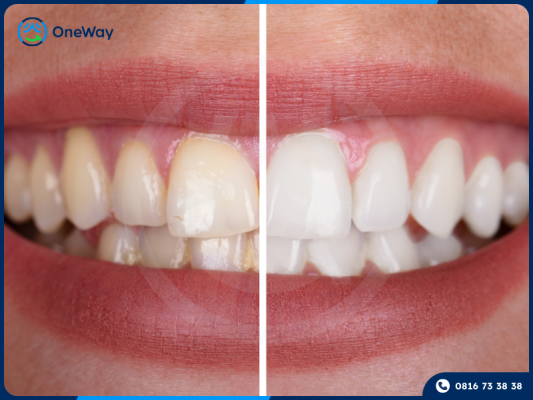 tẩy trắng răng an toàn