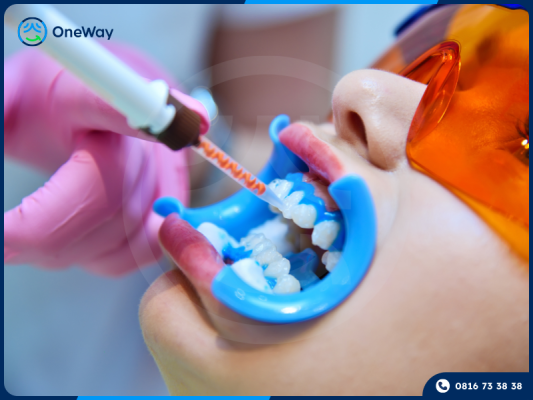 tẩy trắng răng sứ có hiệu quả không