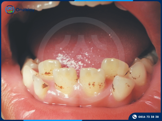 răng ố vàng, vôi răng nhiều