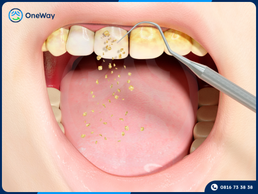 cạo vôi răng