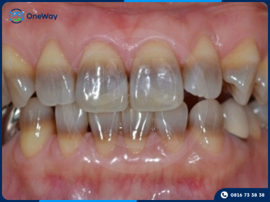 tẩy trắng răng nhiễm tetracycline có hiệu quả không