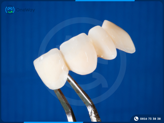 tẩy trắng răng sứ có được không